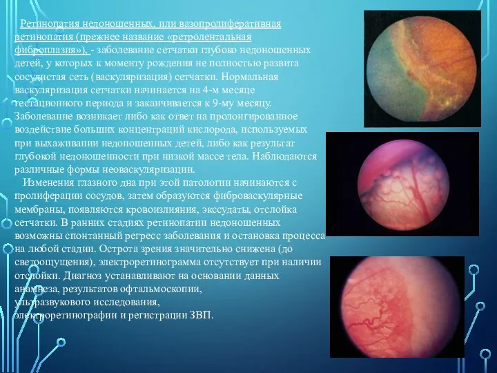 Ретинопатия недоношенных, или вазопролиферативная ретинопатия (прежнее название «ретролентальная фиброплазия»), -