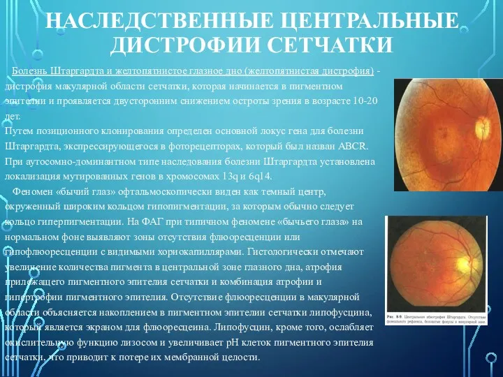 НАСЛЕДСТВЕННЫЕ ЦЕНТРАЛЬНЫЕ ДИСТРОФИИ СЕТЧАТКИ Болезнь Штаргардта и желтопятнистое глазное дно