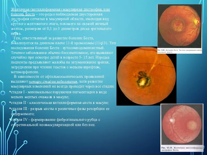 Желточная (вителлиформная) макулярная дистрофия, или болезнь Беста – это редко