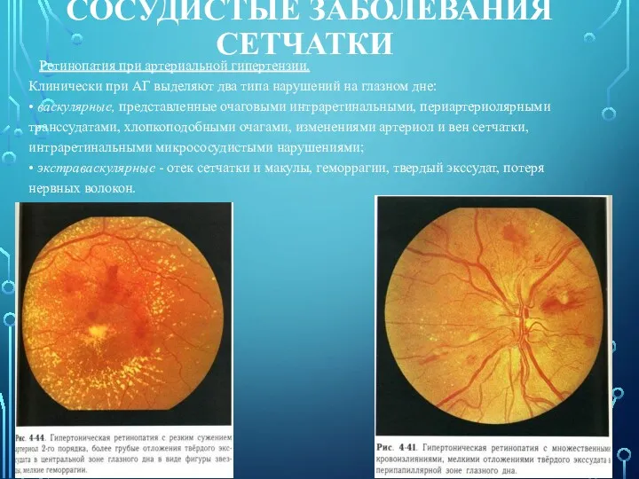 СОСУДИСТЫЕ ЗАБОЛЕВАНИЯ СЕТЧАТКИ Ретинопатия при артериальной гипертензии. Клинически при АГ