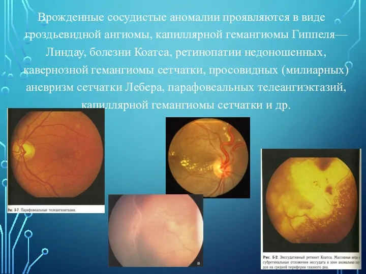 Врожденные сосудистые аномалии проявляются в виде гроздьевидной ангиомы, капиллярной гемангиомы