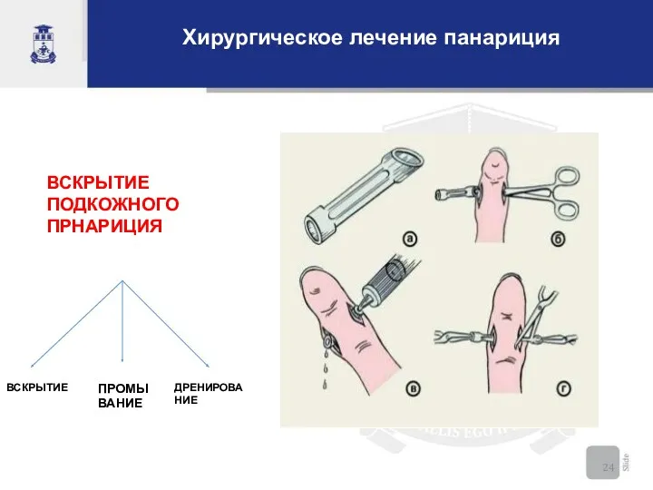 Хирургическое лечение панариция ВСКРЫТИЕ ПОДКОЖНОГО ПРНАРИЦИЯ ВСКРЫТИЕ ПРОМЫВАНИЕ ДРЕНИРОВАНИЕ