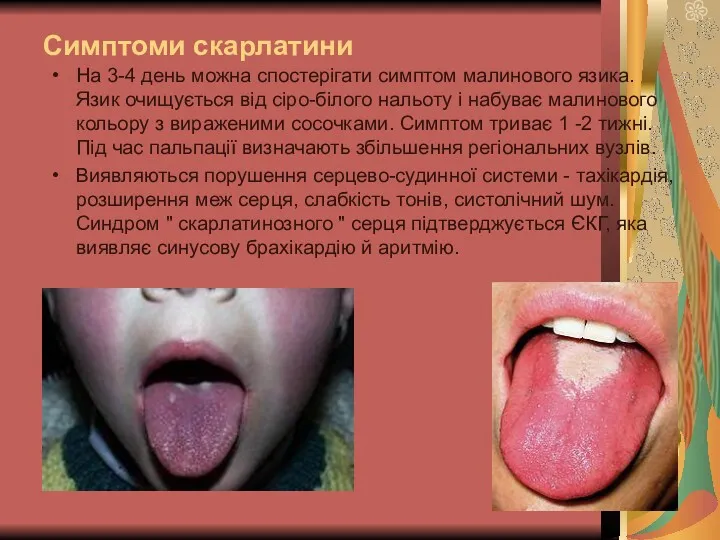 Симптоми скарлатини На 3-4 день можна спостерігати симптом малинового язика. Язик очищується від
