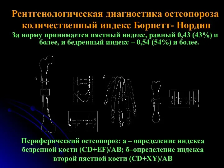 Рентгенологическая диагностика остеопороза количественный индекс Борнетт- Нордин За норму принимается