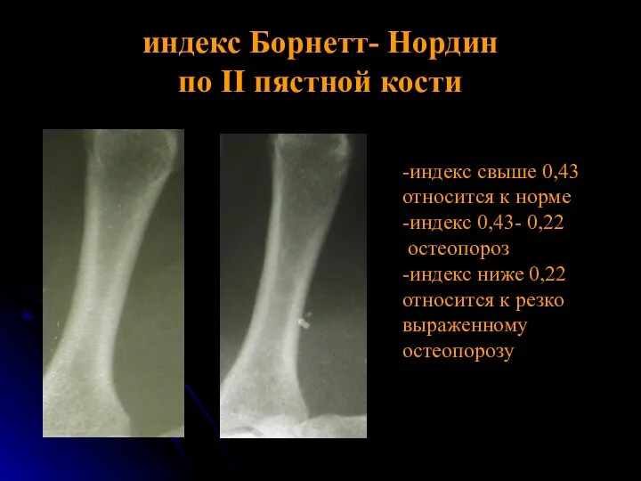 индекс Борнетт- Нордин по II пястной кости -индекс свыше 0,43