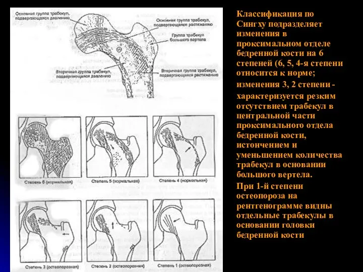 Классификация по Сингху подразделяет изменения в проксимальном отделе бедренной кости