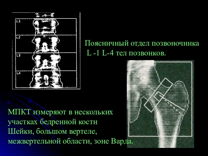 Поясничный отдел позвоночника L -1 L-4 тел позвонков. МПКТ измеряют