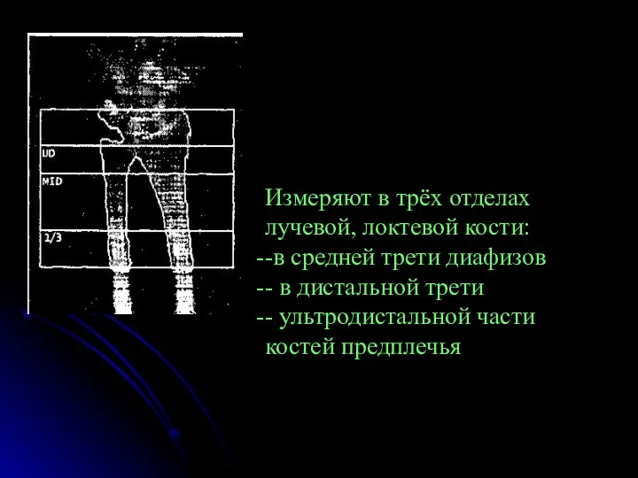 Измеряют в трёх отделах лучевой, локтевой кости: -в средней трети