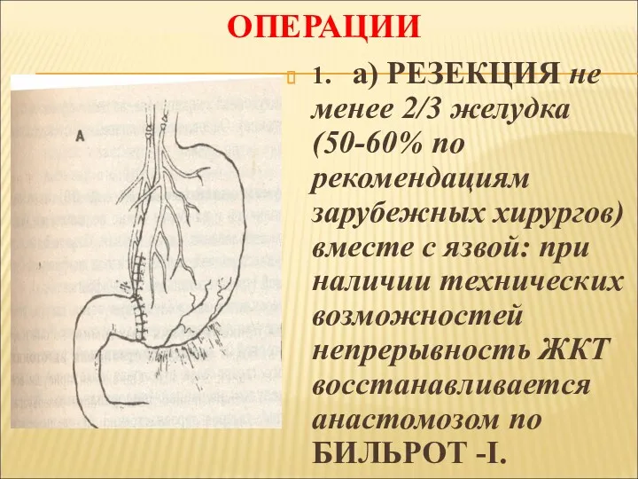 ОПЕРАЦИИ 1. а) РЕЗЕКЦИЯ не менее 2/3 желудка (50-60% по