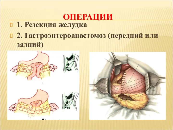 ОПЕРАЦИИ 1. Резекция желудка 2. Гастроэнтероанастомоз (передний или задний)