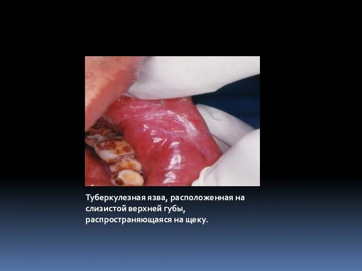 Туберкулезная язва, расположенная на слизистой верхней губы, распространяющаяся на щеку.