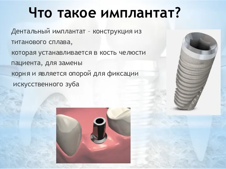 Что такое имплантат? Дентальный имплантат – конструкция из титанового сплава,