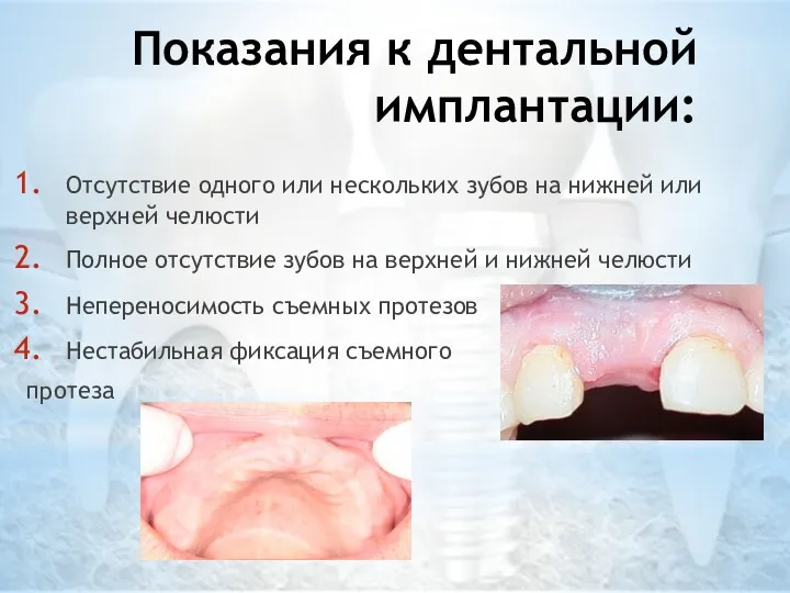 Показания к дентальной имплантации: Отсутствие одного или нескольких зубов на