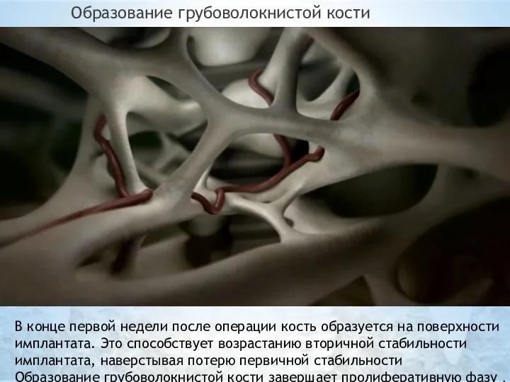 Образование грубоволокнистой кости В конце первой недели после операции кость