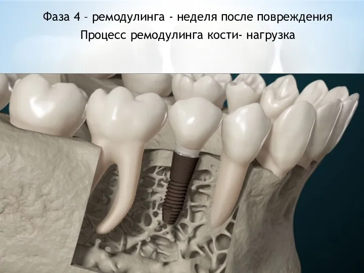 Фаза 4 – ремодулинга - неделя после повреждения Процесс ремодулинга кости- нагрузка