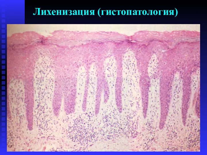 Лихенизация (гистопатология)