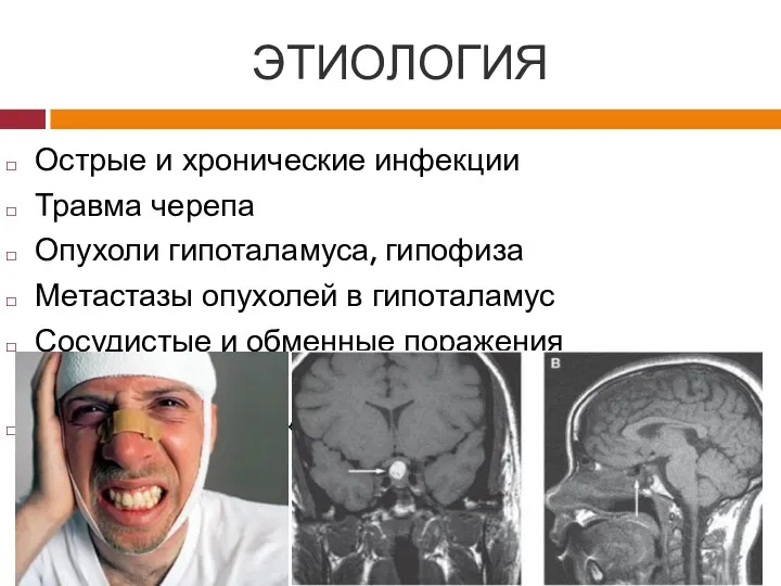 ЭТИОЛОГИЯ Острые и хронические инфекции Травма черепа Опухоли гипоталамуса, гипофиза