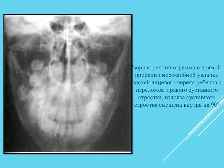 Обзорная рентгенограмма в прямой проекции носо-лобной укладки костей лицевого черепа
