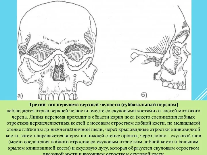 Третий тип перелома верхней челюсти (суббазальный перелом) наблюдается отрыв верхней