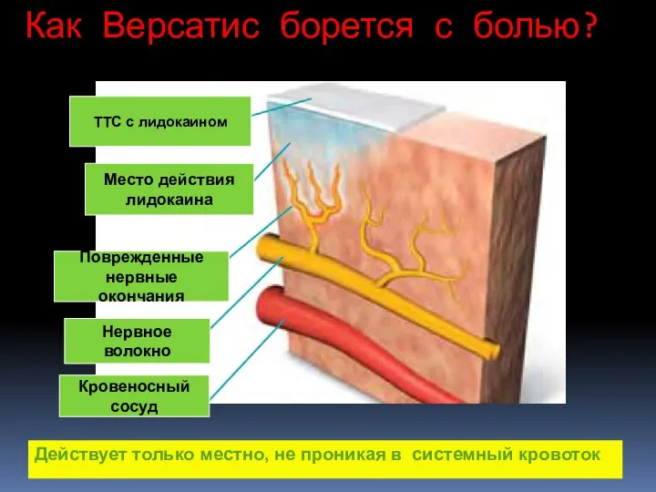 Как Версатис борется с болью? ТТС с лидокаином Место действия