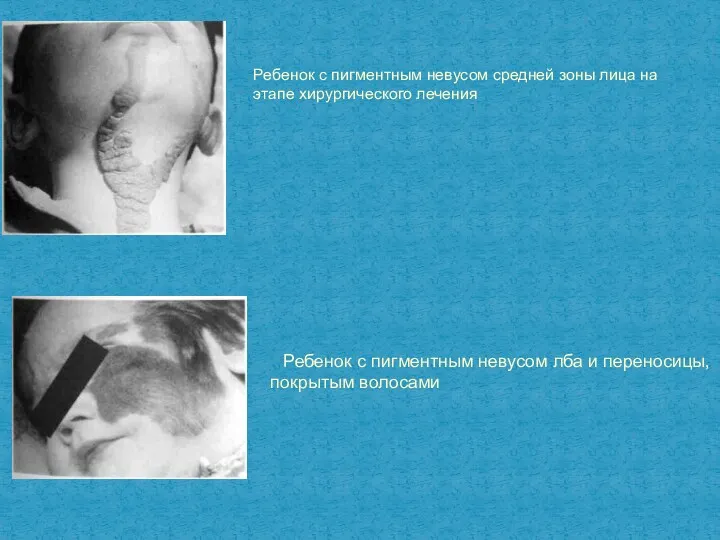 Ребенок с пигментным невусом средней зоны лица на этапе хирургическо­го