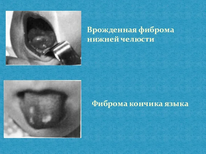 Врожденная фиброма нижней челюсти Фиброма кончика языка