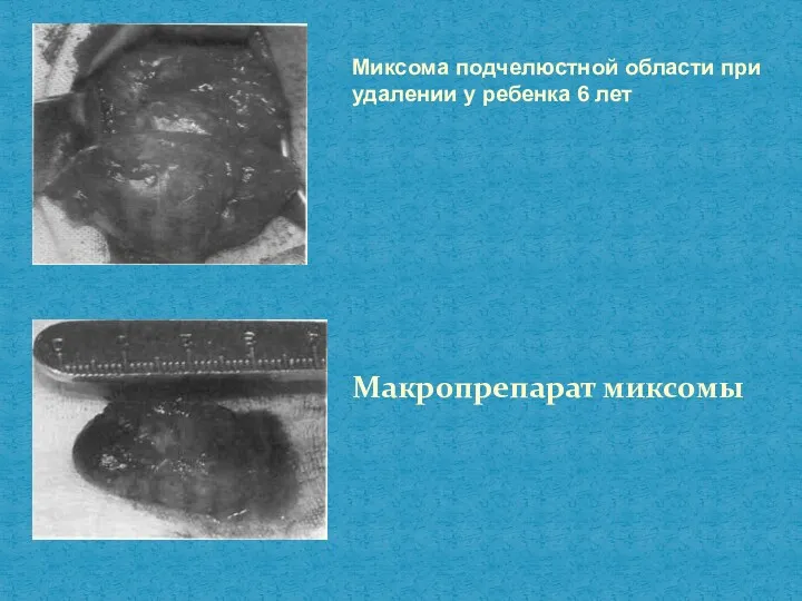 Миксома подчелюстной области при удалении у ребенка 6 лет Макропрепарат миксомы