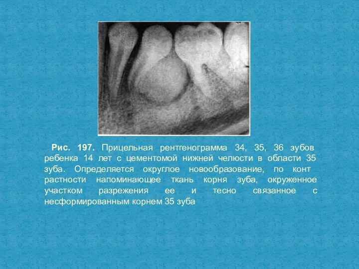 Рис. 197. Прицельная рентгенограмма 34, 35, 36 зубов ребенка 14