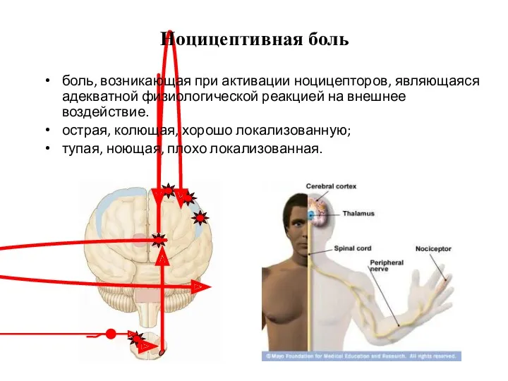 Ноцицептивная боль боль, возникающая при активации ноцицепторов, являющаяся адекватной физиологической