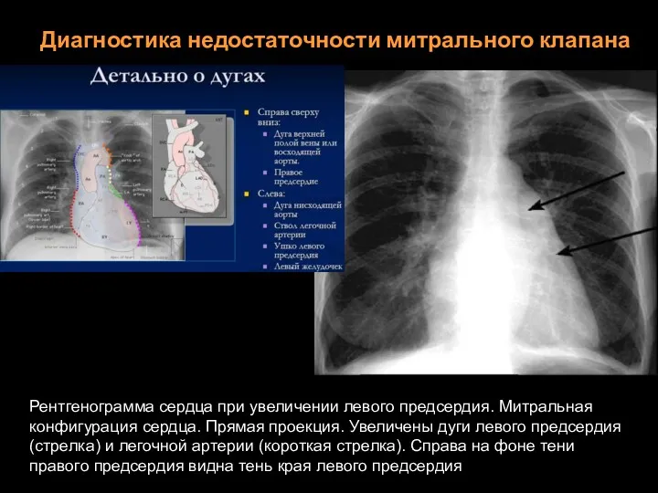 Диагностика недостаточности митрального клапана Рентгенограмма сердца при увеличении левого предсердия.