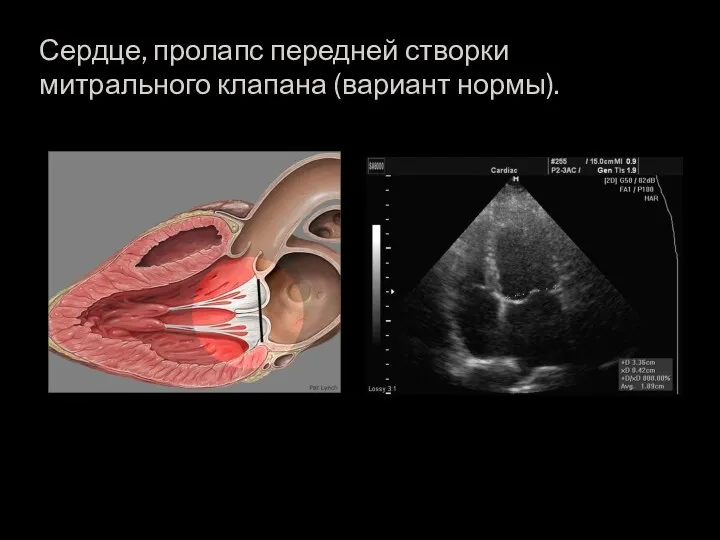 Сердце, пролапс передней створки митрального клапана (вариант нормы).