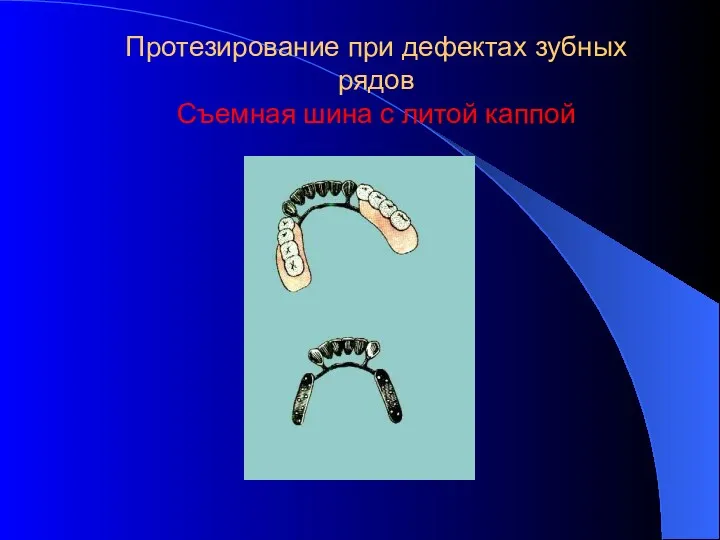 Протезирование при дефектах зубных рядов Съемная шина с литой каппой