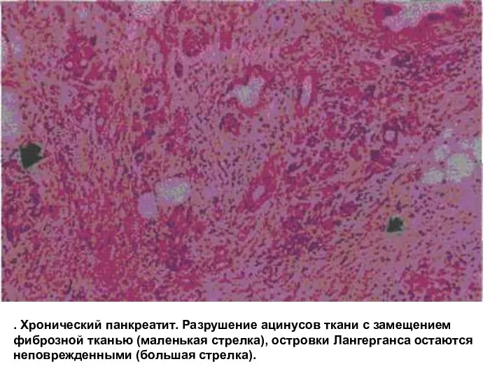 . Хронический панкреатит. Разрушение ацинусов ткани с замещением фиброзной тканью