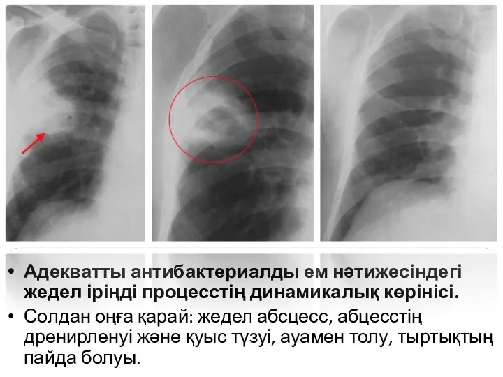 Адекватты антибактериалды ем нәтижесіндегі жедел іріңді процесстің динамикалық көрінісі. Солдан