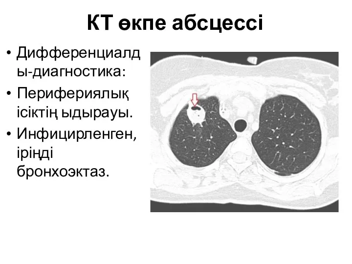 КТ өкпе абсцессі Дифференциалды-диагностика: Перифериялық ісіктің ыдырауы. Инфицирленген, іріңді бронхоэктаз.