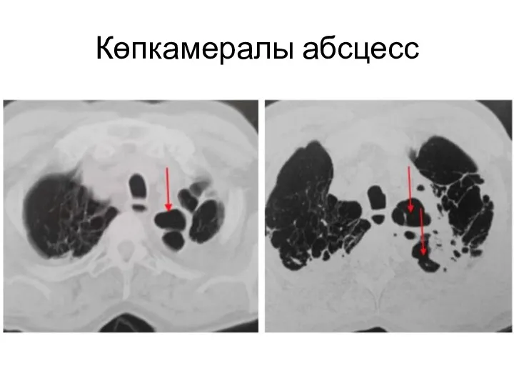 Көпкамералы абсцесс