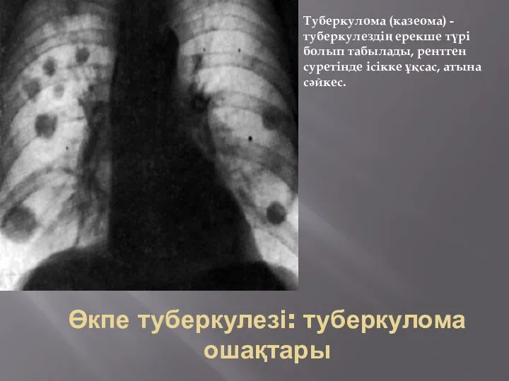 Өкпе туберкулезі: туберкулома ошақтары Туберкулома (казеома) -туберкулездің ерекше түрі болып