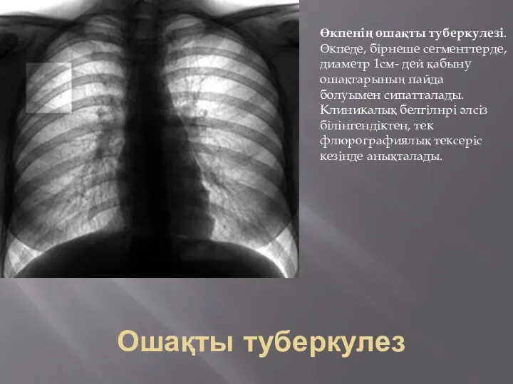 Ошақты туберкулез Өкпенің ошақты туберкулезі. Өкпеде, бірнеше сегменттерде, диаметр 1см-