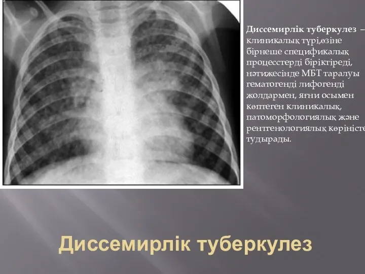 Диссемирлік туберкулез Диссемирлік туберкулез —клиникалық түрі,өзіне бірнеше спецификалық процесстерді біріктіреді,