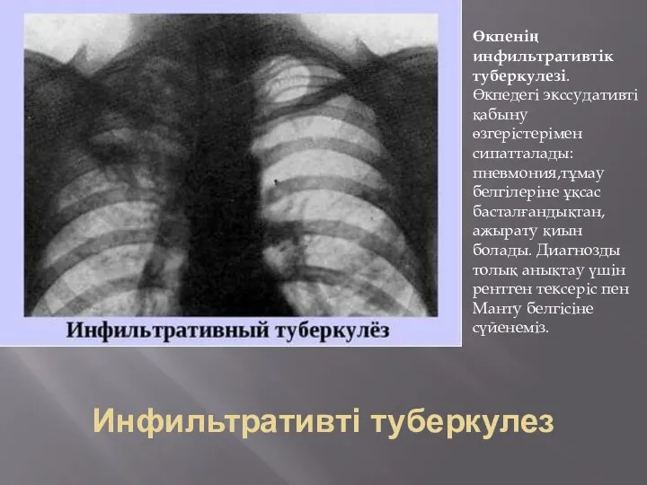 Инфильтративті туберкулез Өкпенің инфильтративтік туберкулезі. Өкпедегі экссудативті қабыну өзгерістерімен сипатталады: