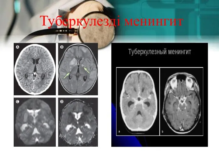 Туберкулезді менингит