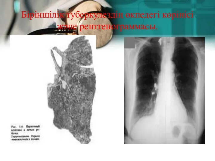 Біріншілік туберкулездің өкпедегі көрінісі және рентгенограммасы.