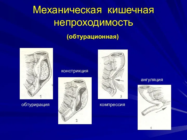 Механическая кишечная непроходимость обтурирация констрикция компрессия ангуляция (обтурационная)