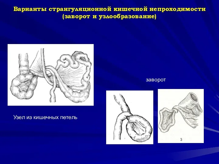 Варианты странгуляционной кишечной непроходимости (заворот и узлообразование) Узел из кишечных петель заворот