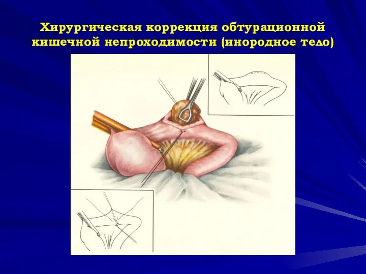 Хирургическая коррекция обтурационной кишечной непроходимости (инородное тело)