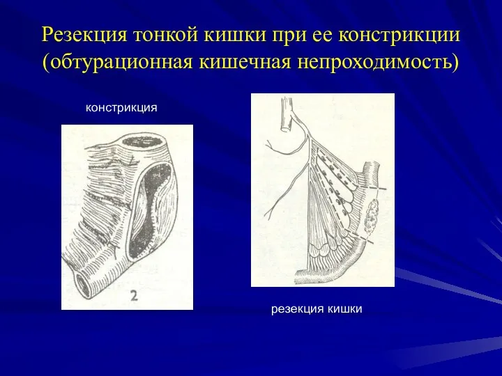 Резекция тонкой кишки при ее констрикции (обтурационная кишечная непроходимость) констрикция резекция кишки