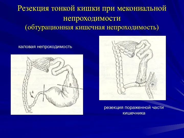 Резекция тонкой кишки при мекониальной непроходимости (обтурационная кишечная непроходимость) каловая непроходимость резекция пораженной части кишечника