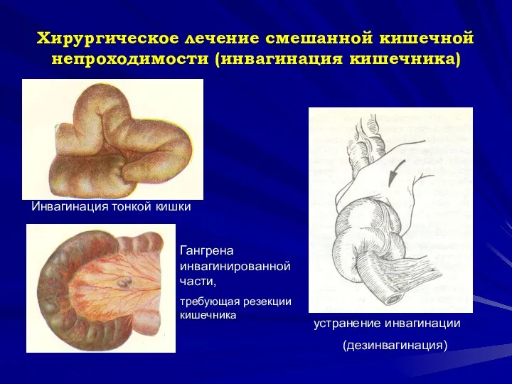 Хирургическое лечение смешанной кишечной непроходимости (инвагинация кишечника) Инвагинация тонкой кишки