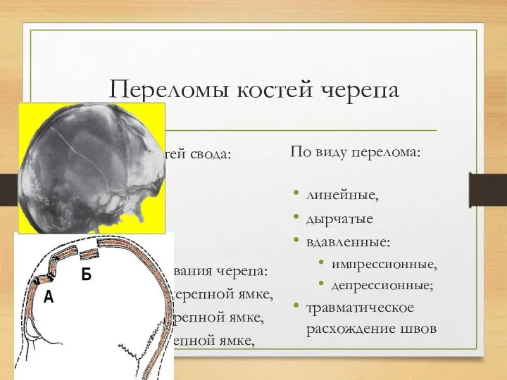 Переломы костей черепа Переломы костей свода: лобной, височной, теменной, затылочной