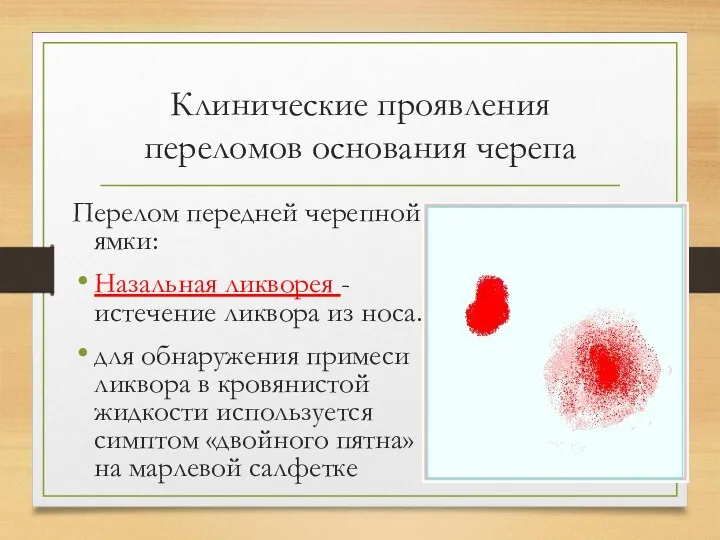 Клинические проявления переломов основания черепа Перелом передней черепной ямки: Назальная